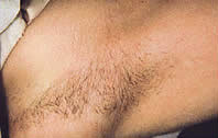 IPL Hair Removal