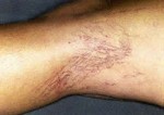 IPL Spider Veins