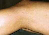 IPL Spider Veins