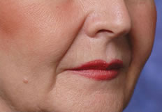 Restylane®