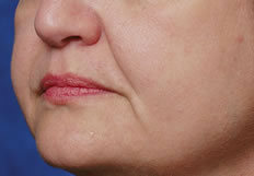 Restylane®