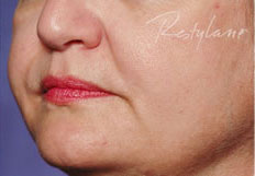 Restylane®