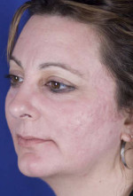 Laser Skin Resurfacing