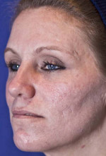 Laser Skin Resurfacing