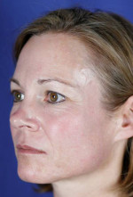 Laser Skin Resurfacing