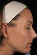 Laser Skin Resurfacing