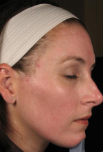 Laser Skin Resurfacing