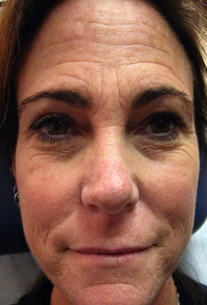 Laser Skin Resurfacing