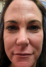 Laser Skin Resurfacing