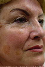 Laser Skin Resurfacing