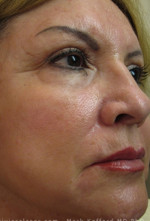 Laser Skin Resurfacing