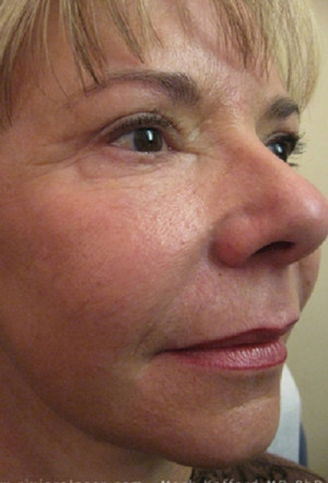 Laser Skin Resurfacing