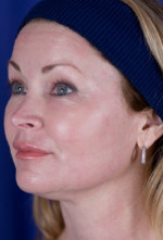 Laser Skin Resurfacing