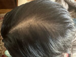 PRP Hair Restoration