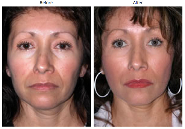 Thermage Result Beverly Hills
